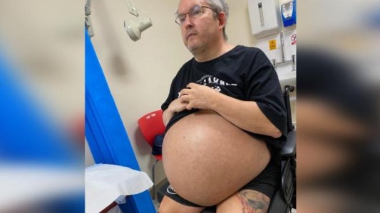 Peligra la vida del hombre con los riñones más grandes del mundo: "Me aplastan el corazón"