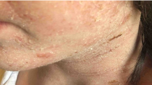 Tiene 14 años, sufre un eccema muy grave y pide entrar en coma porque ya no soporta el dolor