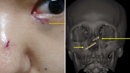 Una mujer pasó una semana con palillos de plástico en el cráneo casi sin darse cuenta