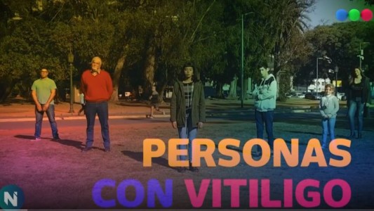 Minorías: Personas con vitíligo