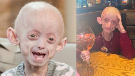 Murió a los 18 años por la enfermedad de Benjamin Button: le dejó el cuerpo de una mujer de 144