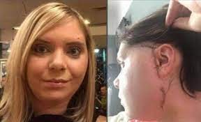 Pidió una hamburguesa triple y se dislocó la mandíbula: "Se arruinó mi vida"