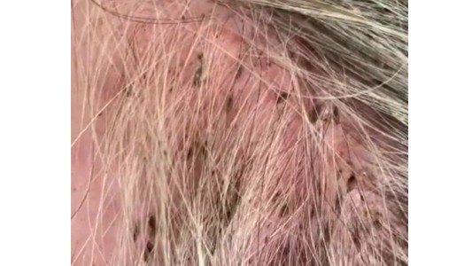 Video: internaron a una mujer de 90 años por una grave infección de piojos en su cabeza