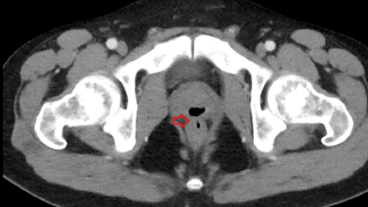 Médicos descubrieron que un hombre eyaculó por el ano durante más de dos años