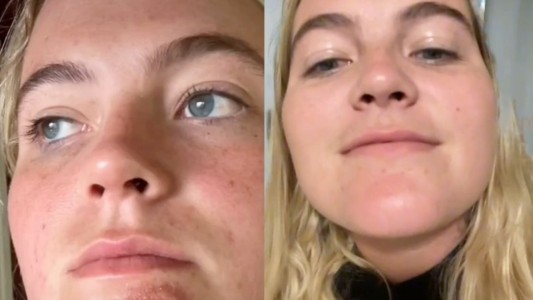 Una chica sufrió una grave infección tras besar a un hombre con barba