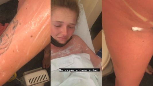 Una joven hizo dos sesiones seguidas de cama solar y terminó internada con quemaduras graves