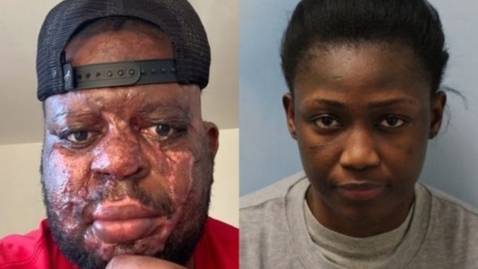 Le tiró ácido en la cara a su novio mientras dormía porque creía que le era infiel