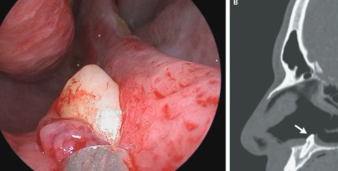 Le costaba respirar, fue al médico y descubrió que le había crecido un diente en la nariz