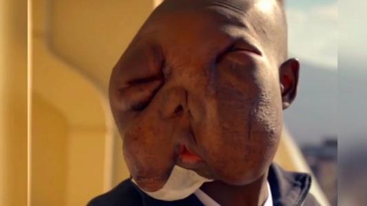 Padecía un extraño tumor que le desfiguró la cara, su mamá lo abandonó, encontró la cura y luce su nuevo rostro