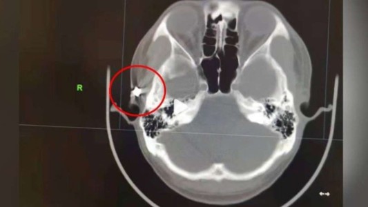 Pasó 20 años con una bala en el cráneo sin saberlo