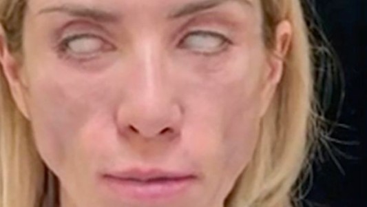 La rusa reina de belleza que no puede cerrar los ojos ni sonreír por culpa de una cirugía estética