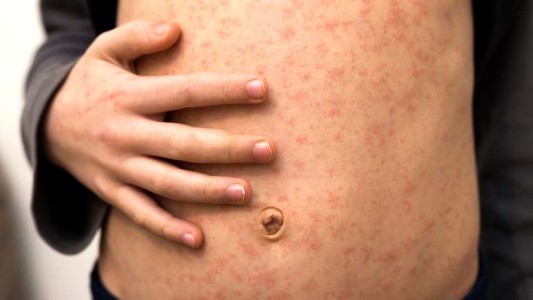 Sarampión: cómo se contagia, quiénes deben vacunarse, quiénes no y, ¿es mortal?