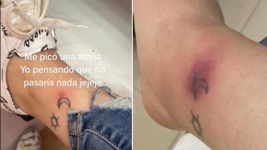 "Pensé que no pasaría nada": mostró cómo le quedó el pie tras la picadura de una viuda negra