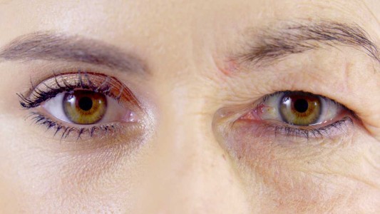 Blefaroplastía, la cirugía que puede solucionar la caída de párpados