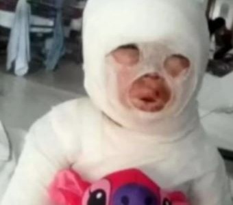 Florencio Varela: una empleada de un restaurante se tropezó y le volcó aceite hirviendo a una nena de 3 años