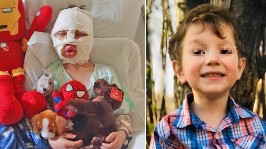 Bullying: un nene de 6 años sufrió quemaduras tras el ataque de otros chicos con una pelota de tenis en llamas