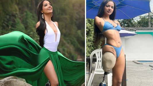 Perdió tres extremidades, se convirtió en modelo y no se deja afectar por los comentarios negativos
