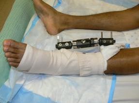 Ingresó a robar, se fracturó una pierna y fue detenido