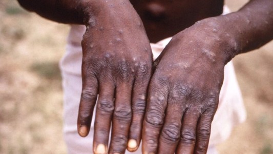 Viruela del mono: la OMS convocará al comité de emergencias tras el aumento de casos