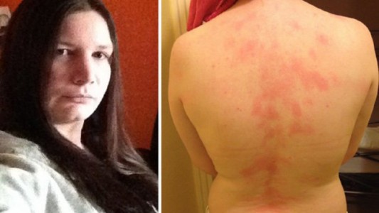 Conocé a la mujer que es alérgica al agua, sudor, lágrimas y besos