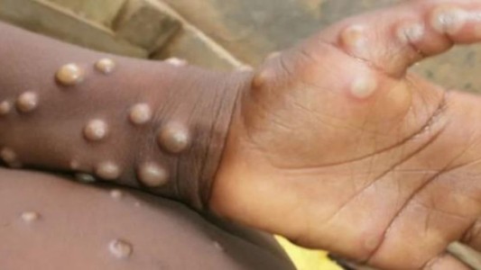 Confirmaron tres nuevos casos de la viruela del mono en Argentina