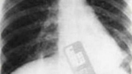 Un ginecólogo dejó su celular dentro del vientre de una paciente
