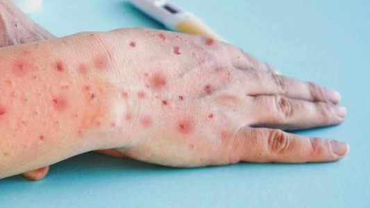 Perú: murió por septicemia una persona infectada con viruela del mono