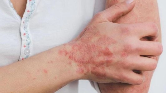 Viruela del mono: España ya superó los 5.000 casos confirmados