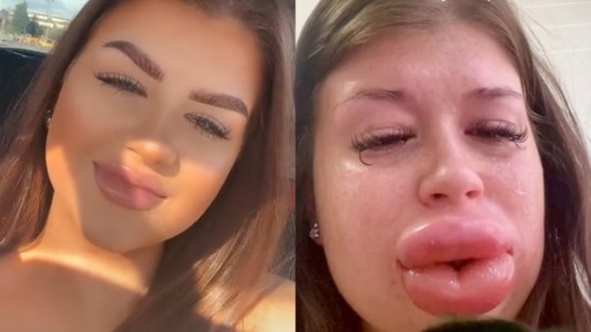 Rompió en llanto al comprobar que su cara se deformaba por un tratamiento estético fallido