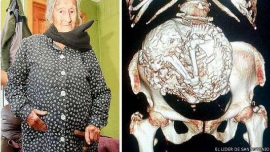 Una anciana de 92 años lleva en su vientre un feto momificado