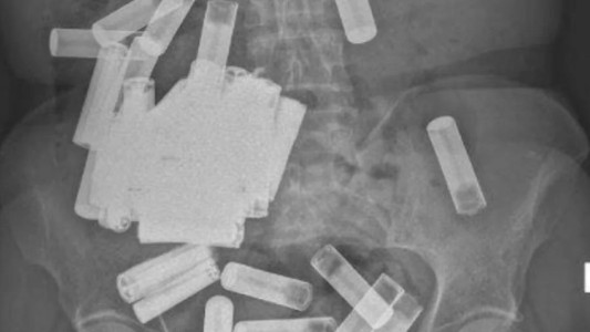 Tenía dolor de panza y le extrajeron 55 pilas del cuerpo