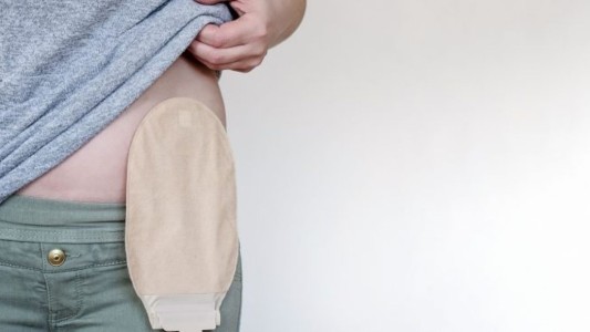 Once provincias adhirieron a la ley que da cobertura a personas ostomizadas