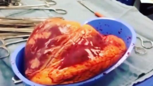 El corazón de un adicto a la cocaína latió durante 25 minutos fuera de su cuerpo