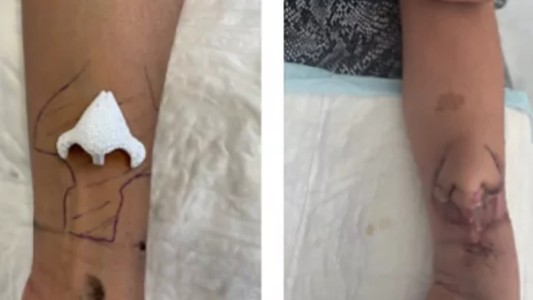 Injertaron la nariz en el brazo a una mujer para que recupere su olfato tras sufrir un cáncer