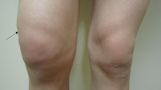 Consiguen identificar la progresión de la artrosis con un análisis de sangre