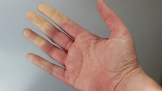 Indemnización millonaria para una paciente que tuvo grave consecuencias en sus manos por demoras en una medicación