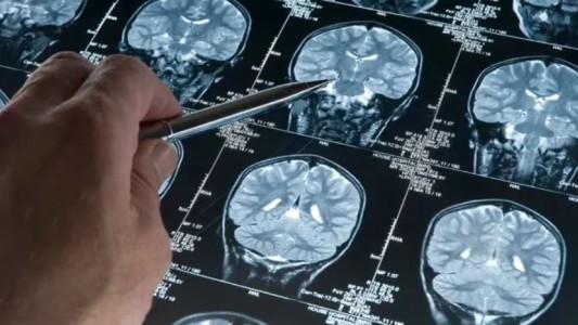 Científicos de la UBA investigan cómo detectar el Alzheimer con inteligencia artificial