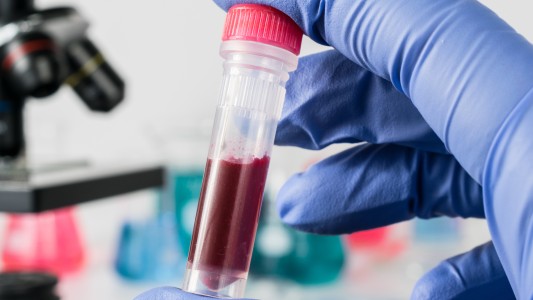 "El paciente de Ginebra": Un nuevo caso de remisión del VIH tras un trasplante de médula ósea