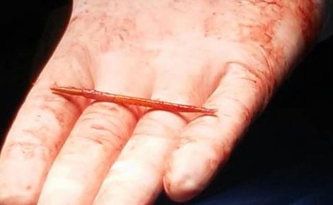 Operación inédita: le sacaron del corazón un escarbadientes que se tragó en una picada
