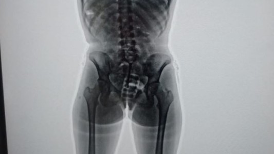 Detuvieron en Ezeiza a una mula argentina que viajaba a Europa con 78 cápsulas de cocaína en el cuerpo