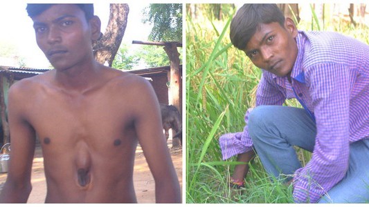 Nació con el corazón fuera del pecho y cualquier golpe podría matarlo