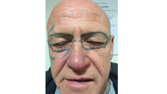 Tras una noche de fiesta  y alcohol, se despertó con anteojos tatuados en la cara