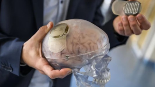 Un implante a prueba permite ayudar a una persona tetrapléjica a mover los brazos y las manos