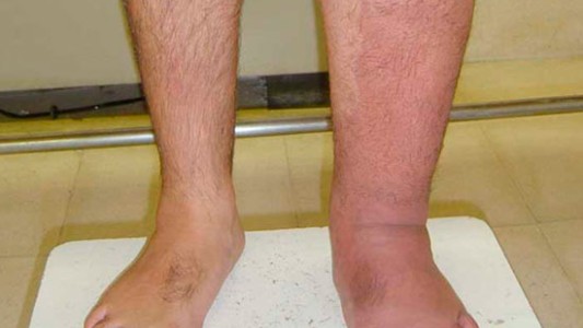 Linfedema: una enfermedad que afecta tanto al cuerpo como al estado anímico