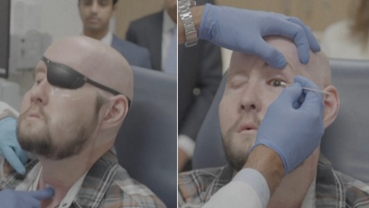 Realizaron el primer trasplante de ojo completo del mundo