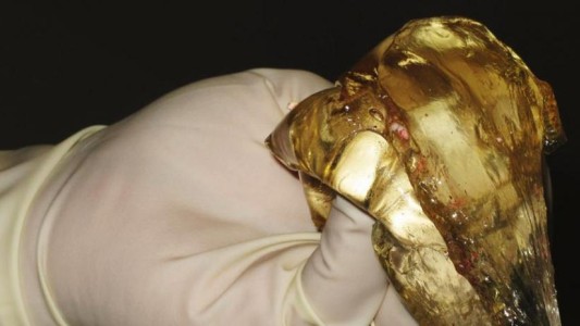 Ordenan indemnizar a 605 mujeres por implantes de prótesis mamarias defectuosas