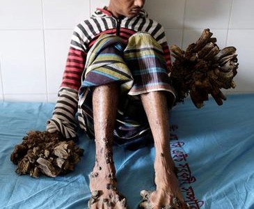 El "hombre árbol" será operado