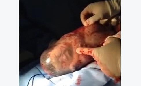 El bebé recién nacido que bosteza dentro del saco amniótico