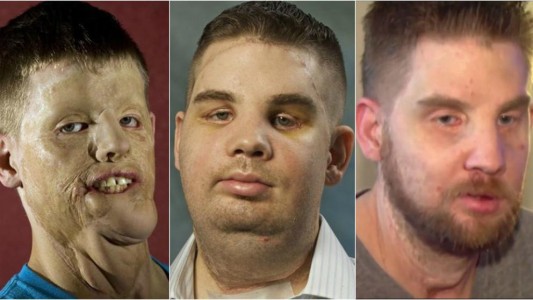 La nueva vida de un trasplantado de cara