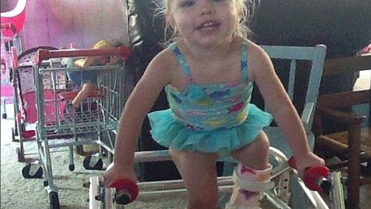 La mujer que tuvo que quebrar 300 veces la pierna de su hija para evitar una amputación